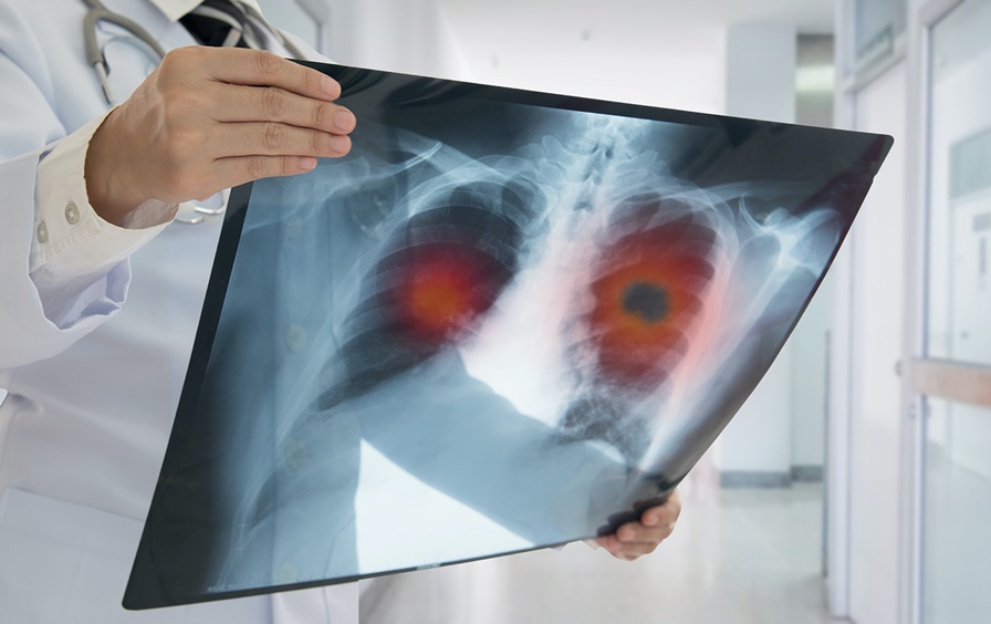 El cáncer de pulmón continúa siendo uno de los más frecuentes diagnosticados en España